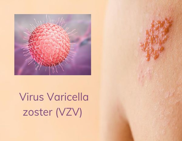 Varicella-zoster là virus gây bệnh zona